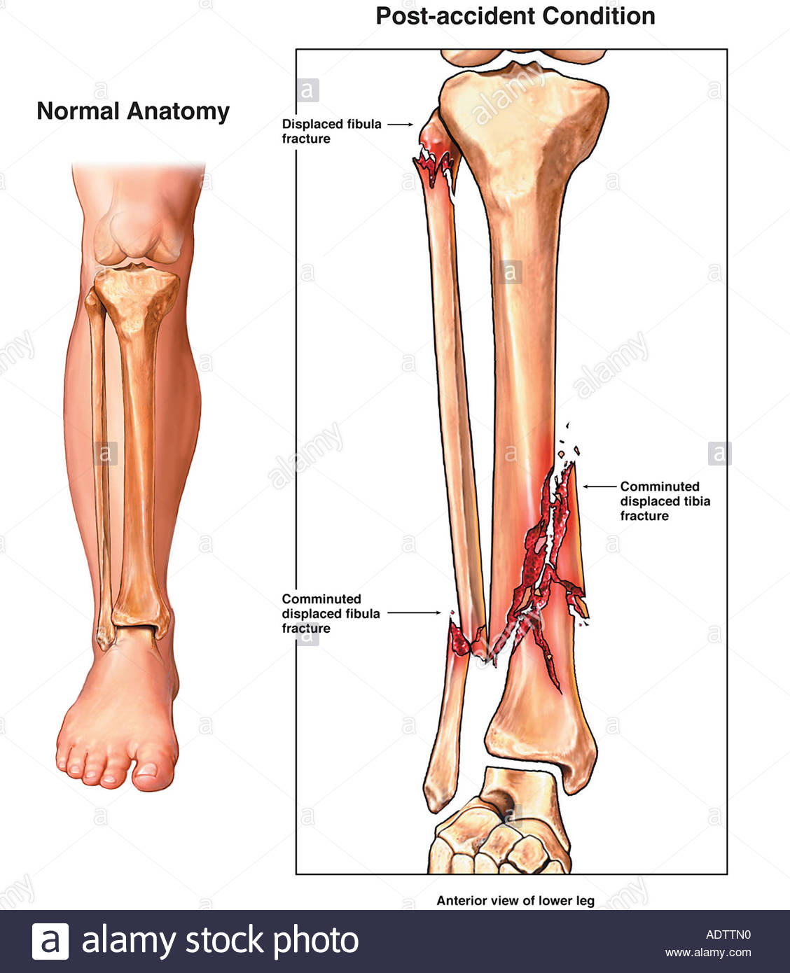 comminuted-and-compound-right-lower-leg-fractures-pilon-fracture-ADTTN0